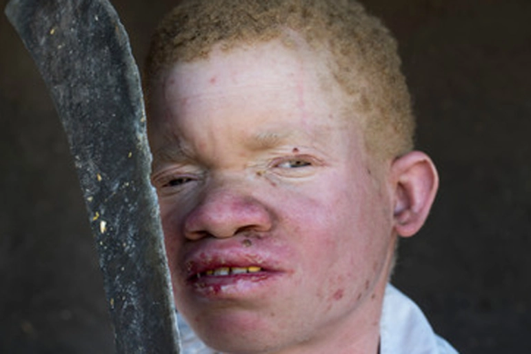 Body parts belonging to people with albinism have become sought after in parts of southern and eastern Africa/ Amnesty International/Aljazeera archive.