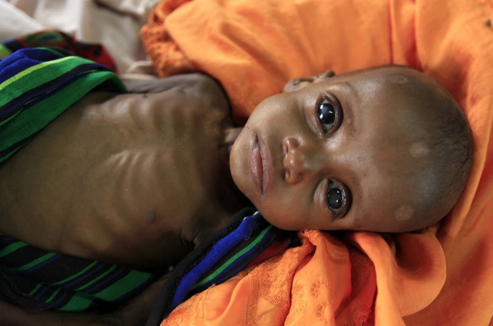 Sudanese children are malnourished – Human Rights & Public Liberties